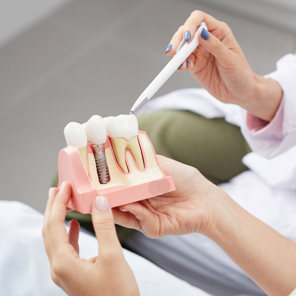 Implanty Zębowe - Blog Stomatologiczny