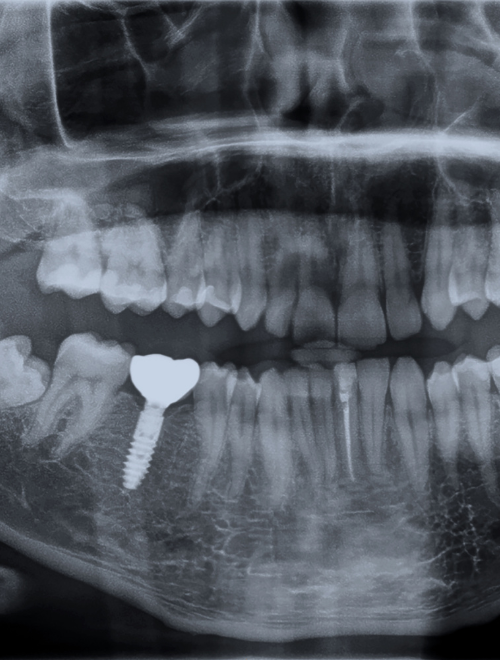 Zdjęcie wszczepionego implanta zębowego