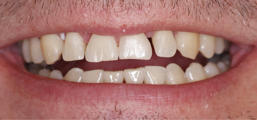 Metamorfoza uśmiechu Warszawa: Zęby przed leczeniem ortodontycznym