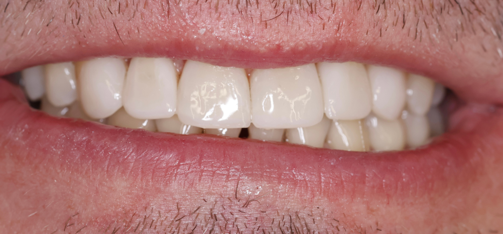 Metamorfoza uśmiechu Warszawa: Zęby po leczeniu aparatem stałym