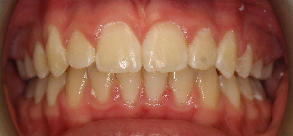 Metamorfoza uśmiechu Warszawa. Efekt leczenia aparatem stałym