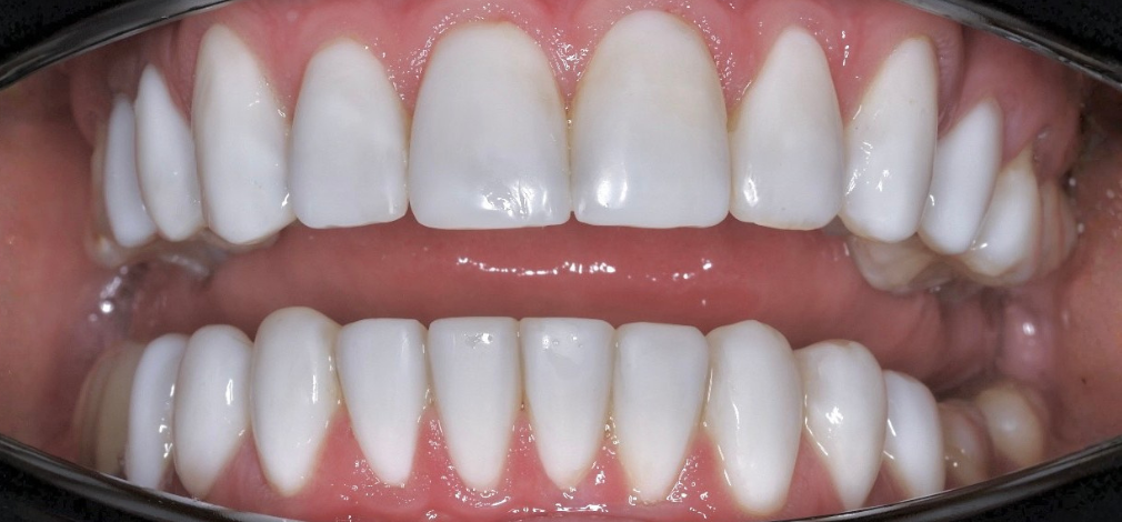 Metamorfoza uśmiechu Warszawa: Zęby po leczeniu ortodontycznym