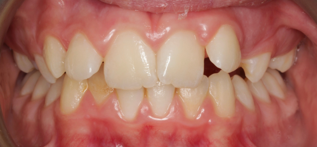 Zęby przed metamorfozą uśmiechu (leczeniu aparatem stałym)