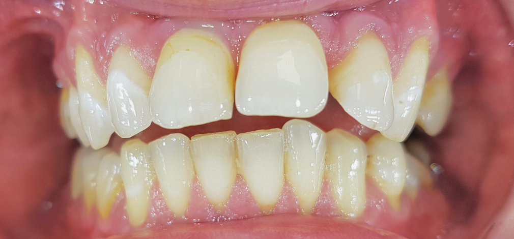 Zęby przed leczeniem ortodontycznym