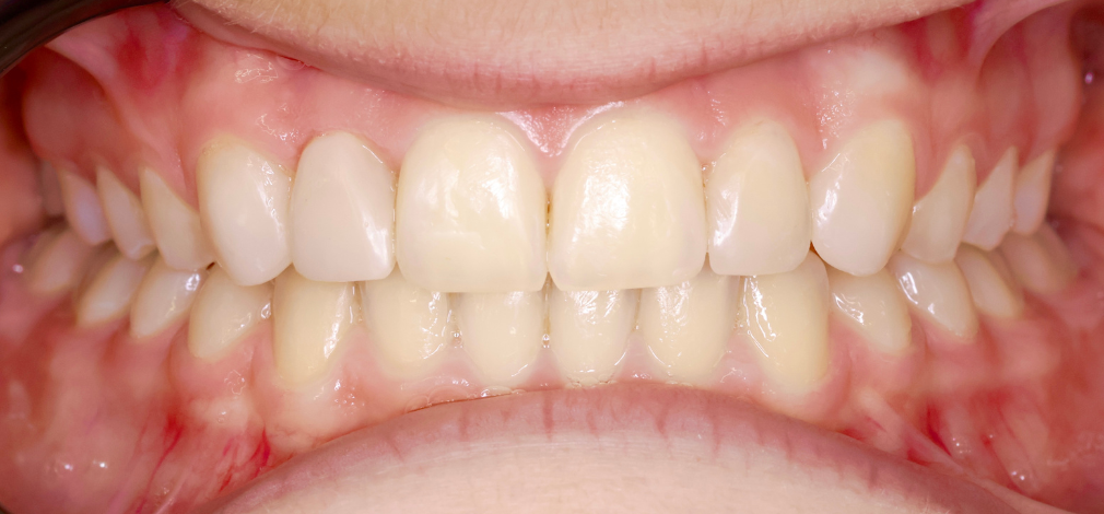 Metamorfoza uśmiechu Warszawa: Efekt po leczeniu zębów i korekcie estetyki