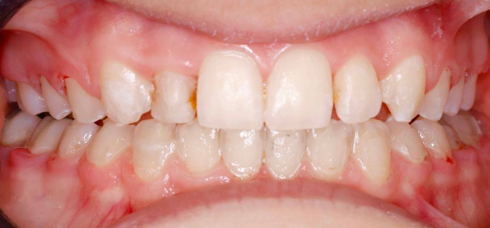 Metamorfoza uśmiechu Warszawa: Zęby przed leczeniem i korektą estetyki