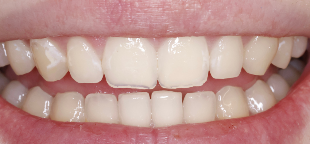 Metamorfoza uśmiechu Warszawa: Zęby przed zastosowaniem preparatu ICON