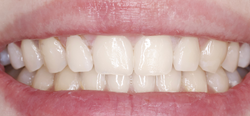 Metamorfoza uśmiechu Warszawa: Efekt leczenia preparatem ICON