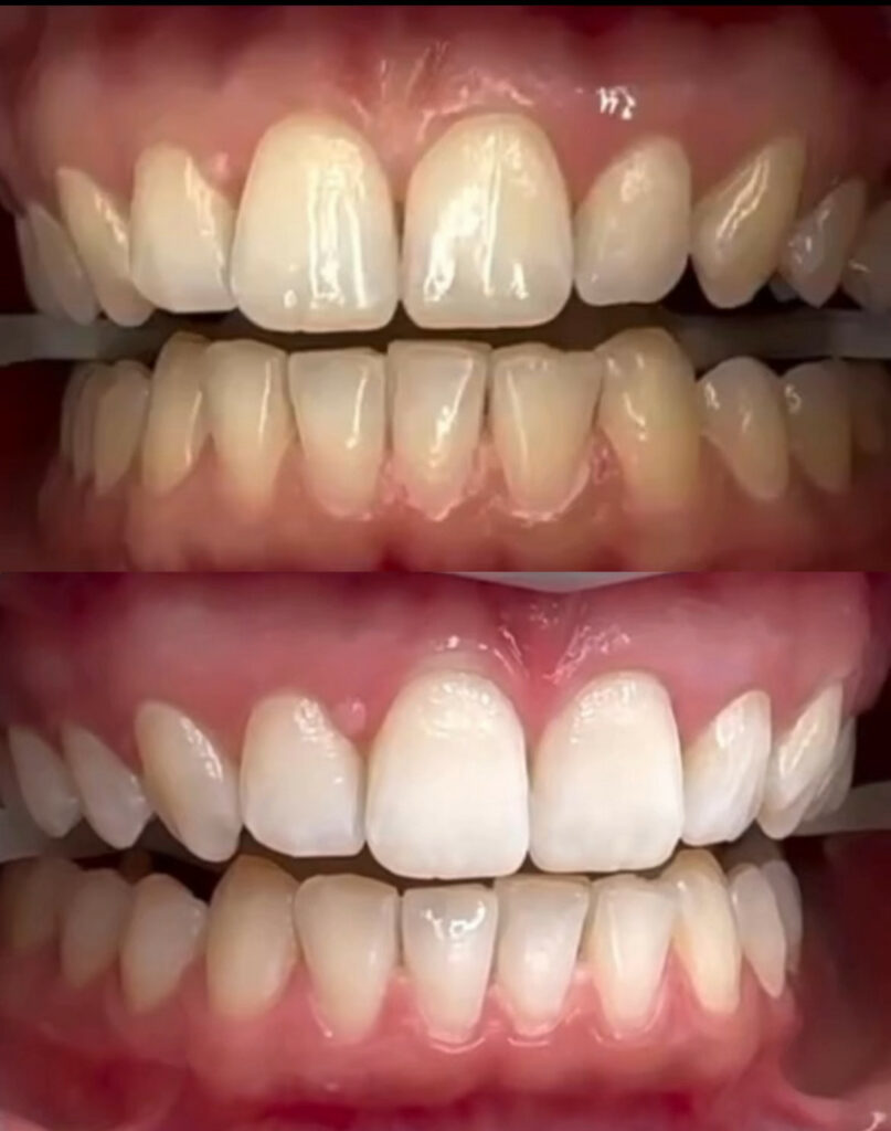 Wybielanie Zębów Warszawa Wola