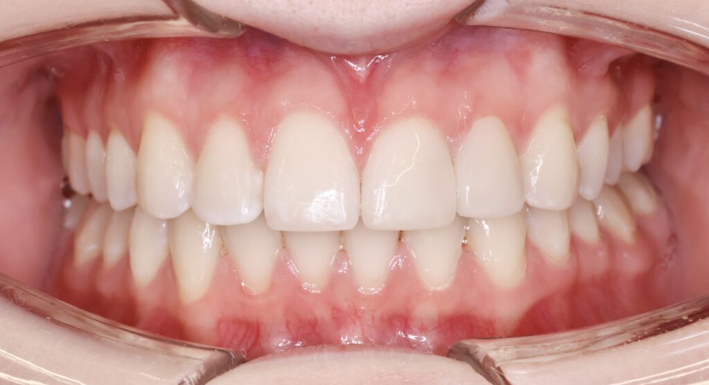 Metamorfoza uśmiechu. Efekt leczenia ortodontycznego, wybielania i bondingu.