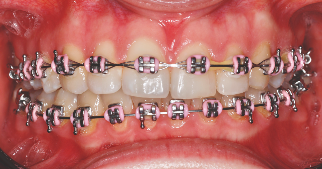 Zęby podczas leczenia ortodontycznego