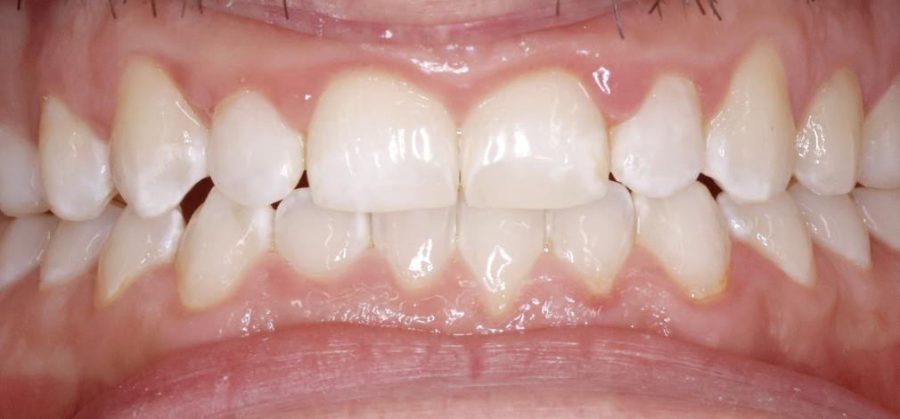 Metamorfoza uśmiechu Warszawa: Zęby po leczeniu nakładkami Invisalign