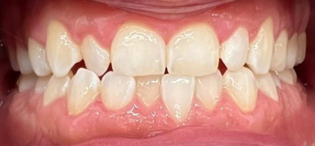 Zęby przed leczeniem nakładkami Invisalign