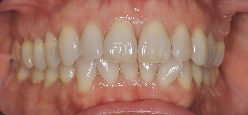 Metamorfoza uśmiechu Warszawa: Zęby przed leczeniem ortodontycznym i wybielaniu