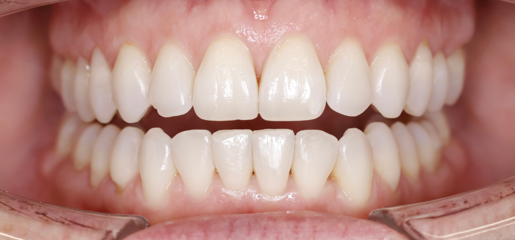 Metamorfoza uśmiechu Warszawa: Efekt po leczeniu Invisalign i Wybielaniu