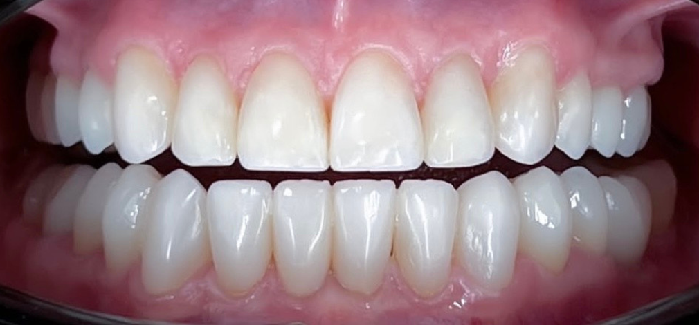 Metamorfoza Uśmiechu Warszawa: Efekt po leczeniu protetycznym