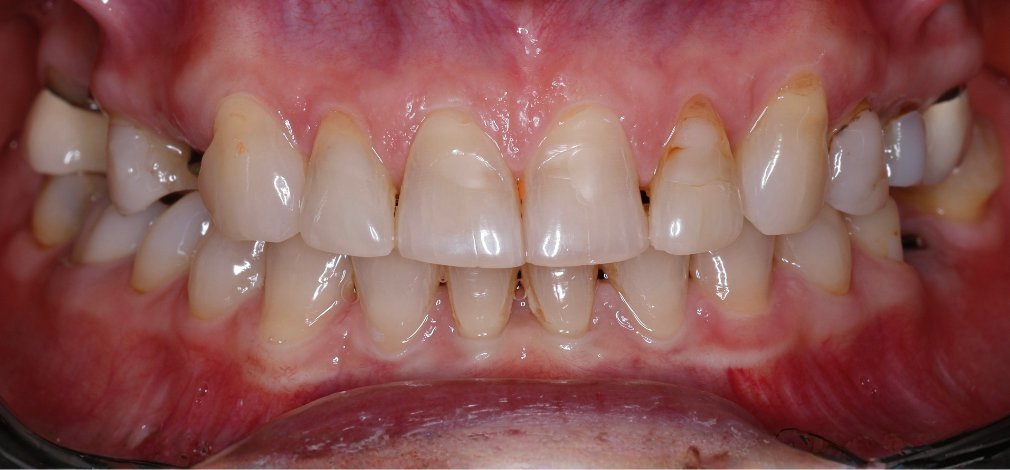 Metamorfoza Uśmiechu Warszawa: Przywrócenie funkcji zgryzu