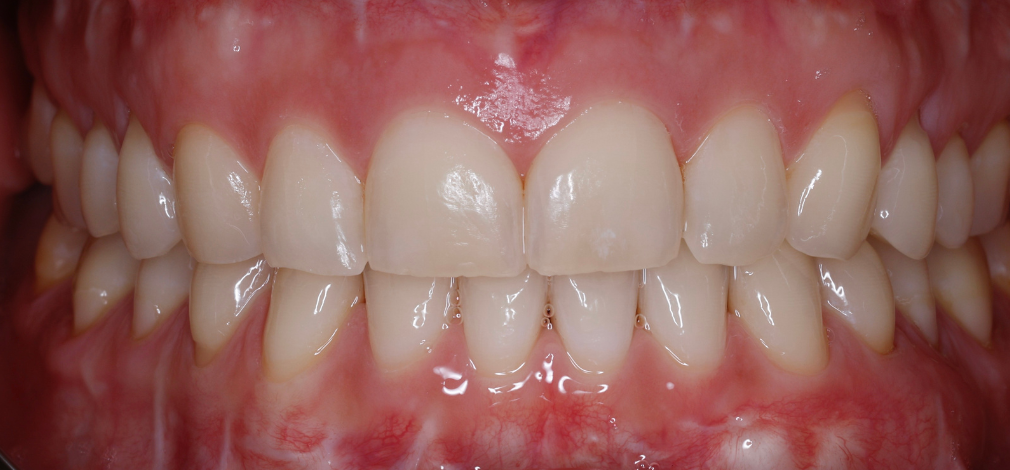 Metamorfoza uśmiechu Warszawa. Efekt leczenia: Zęby po wybielaniu lampą