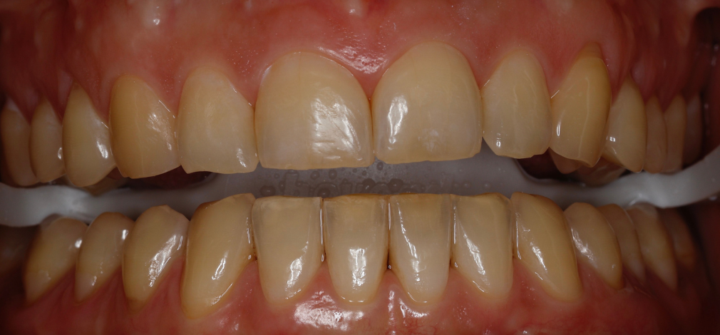 Zęby przed wybielaniem