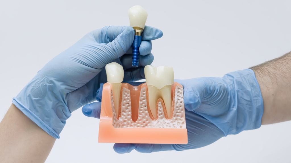 Implant natychmiastowy — kiedy można go założyć w dniu usunięcia zęba