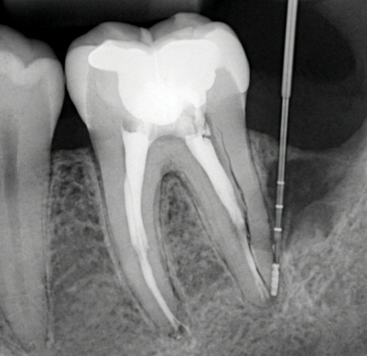 Loose teeth in adults — when a tooth can still be saved